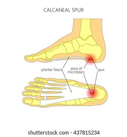 Illustration of the calcaneal spur.  Used: gradient, transparency, blend mode.