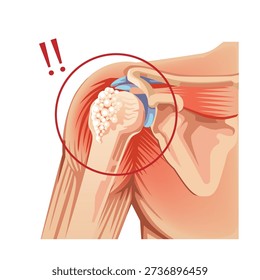 Illustration of Calcific Shoulder Tendinitis Shoulder Joint with Arthritis