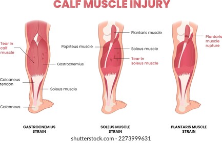 illustration of calf muscle injury infographic - vector