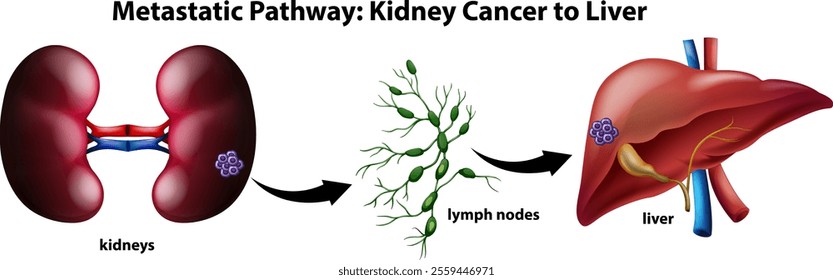 Illustration of cancer spread from kidney to liver