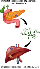 Illustration of cancer spreading to the liver