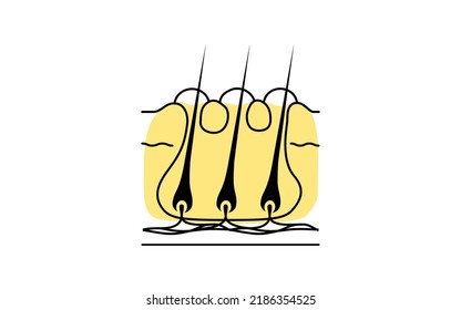 Illustration of a "carbuncle," a subcutaneous connection of multiple furuncles aggravated by folliculitis.