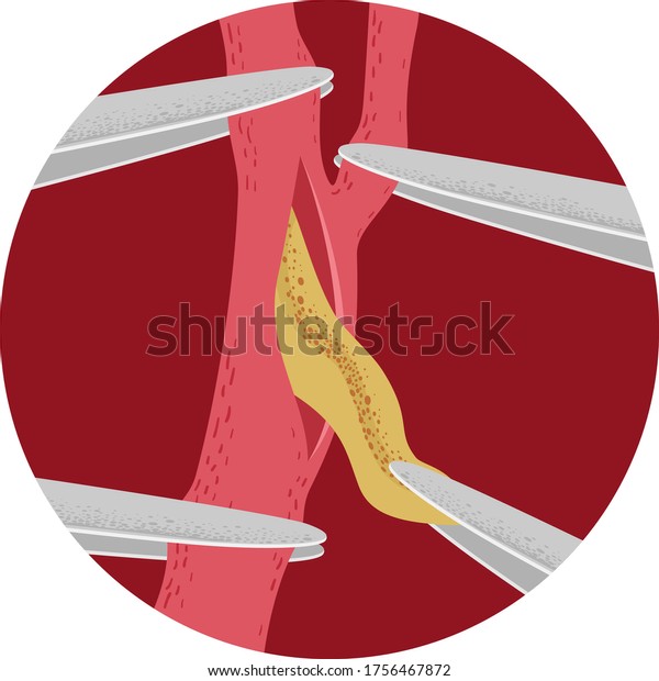 Illustration of Carotid Artery Surgery Removing
the Plaque Using
Hemostat