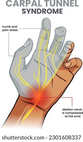 illustration of carpal tunnel syndrome with the numb area in hand