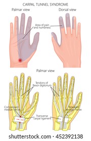 Illustration of The Carpal Tunnel Syndrome problem and surgery. Used gradient, transparency.