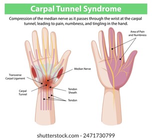 Illustration of carpal tunnel syndrome symptoms and anatomy