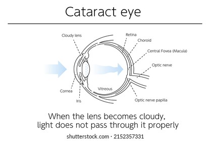 Illustration, Cataract Eye, Medical Illustrations.