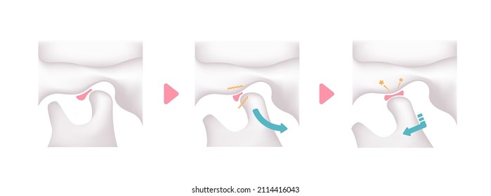 Illustration of the cause of temporomandibular disorders (TMD)