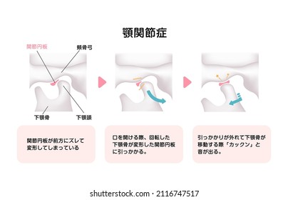 Illustration of the cause of temporomandibular disorders (TMD). Translation: Temporomandibular disorders , Articular disk, Zygomatic arch, Mandible, Head of Mandible