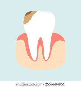 Illustration of Cavity Toothache Problems