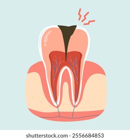 Illustration of Cavity Toothache Problems