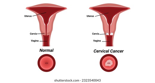 Illustration of cervical cancer vector