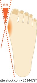 Illustration of checking the angle of the big toe. The meaning of the written Japanese is angle.