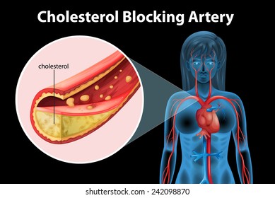 171 Arterial sclerosis Images, Stock Photos & Vectors | Shutterstock