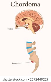 Illustration of chordoma tumors located at the skull base and sacrum in the spine. eps 10