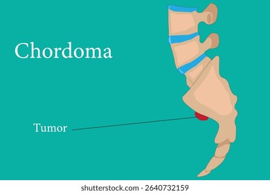Illustration of chordoma tumors located at the skull base and sacrum in the spine. eps 10