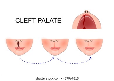 illustration of a cleft palate in a child. plastic surgery. reconstruction of the upper palate
