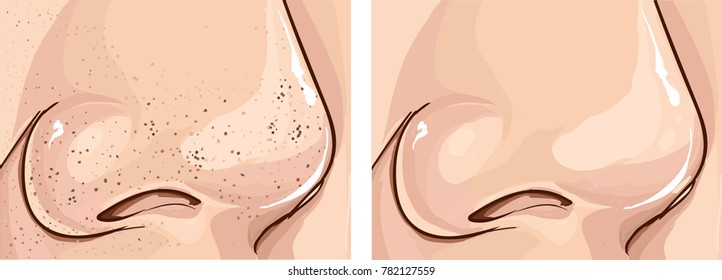  Illustration Of Clogged Pores And Clean Pores On Nose