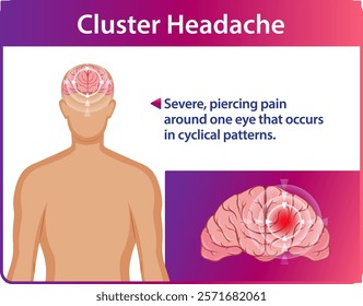 Illustration of cluster headache pain and brain impact