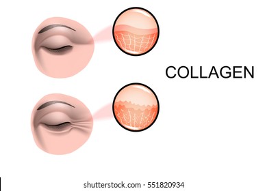 illustration of collagen damage. for advertising and other medical publications