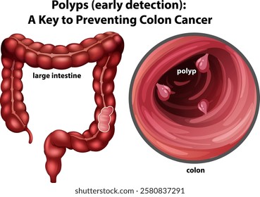 Illustration of colon polyps and large intestine
