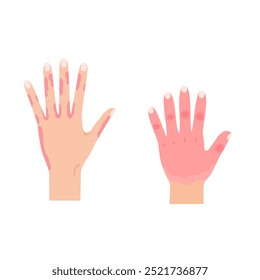 Illustration of common areas where chilblains occur (adult and child hands)