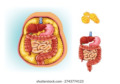 Illustration comparing abdominal organs with excess visceral fat and normal internal anatomy.