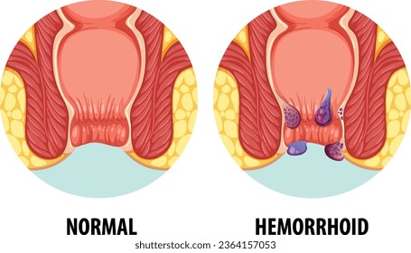 Ilustración comparando anatomía normal con condición hemorroide