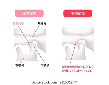 Illustration comparing the shapes of the articular disk ( normal jaw and Temporomandibular disorders ) . Translation: Normal, Temporomandibular disorders , Articular disk, Zygomatic arch, Mandible etc
