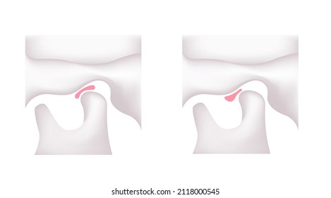 Illustration comparing the shapes of the articular disk ( normal jaw and Temporomandibular disorders ) 