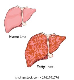 Illustration Comparison Normal Fatty Liver Disease Stock Vector ...