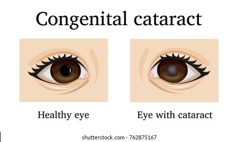 Illustration Of Congenital Cataract In An Infant