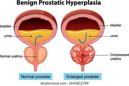 Ilustração contrastando glândulas prostáticas normais e aumentadas, destacando diferenças anatômicas. Rótulos claros e cores vibrantes melhoram a compreensão