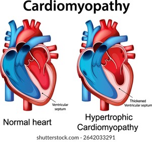 Illustration contrasting a normal heart with hypertrophic cardiomyopathy. Detailed anatomical features, vibrant colors, and clear labeling enhance understanding
