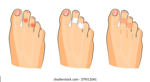 illustration of corns on the toes and glued patches