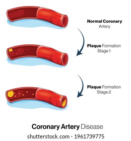 Illustration Coronary Artery Disease Due Fat Stock Vector (Royalty Free ...