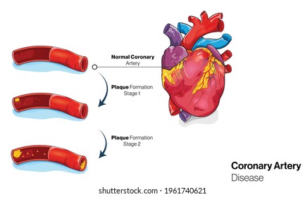 Illustration Of Coronary Artery Disease In Human Heart: Fat Deposition Of Plaque Formation. Vector Illustration. 