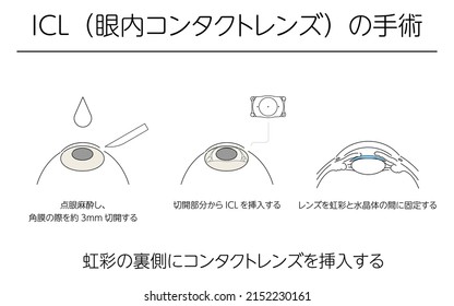 Illustration, Correction of vision with ICL (intraocular contact lens), Medical illustration. - Translation: intraocular contact lens (ICL) surgery, insertion of contact lens behind the iris, ophthalm