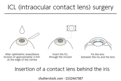 Illustration, Correction of vision with ICL (intraocular contact lens), Medical illustration.