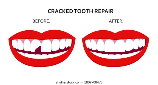 Illustration Cracked Tooth Repair Smile Mouth Stock Vector Royalty