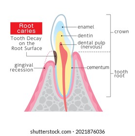 It is an illustration of a cross section of root caries. Since it is vector data, it can be easily edited.