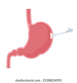 Ilustração de uma seção transversal de um estômago com um tubo de gastrostomia_PEG