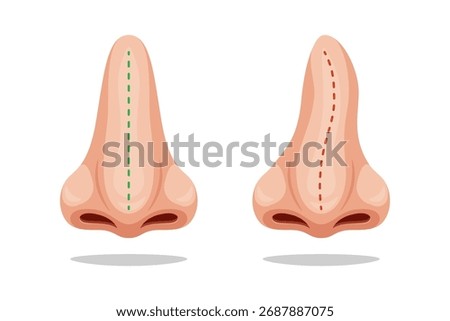 Illustration curve and correct nose, correction nasal curvature. Nose before and after.