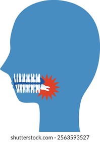 Illustration of a damaged wisdom tooth