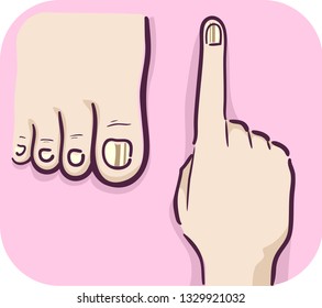 Illustration of Dark Line on Toe Nail and Fingernail