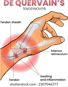 illustration of de quervain syndrome