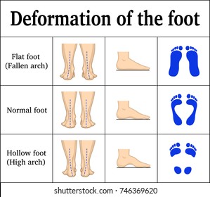 Illustration of the deformation of the foot - flat feet and a hollow foot. There are footprints, the form of the foot on the side and behind