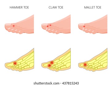 10,642 Claw toes Images, Stock Photos & Vectors | Shutterstock