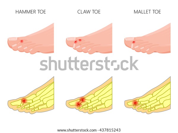 Illustration of the deformation of toes. Used: gradient, transparency, blend mode.