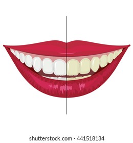 Illustration to demonstrate the effect of whitening and teeth cleaning. Vector.